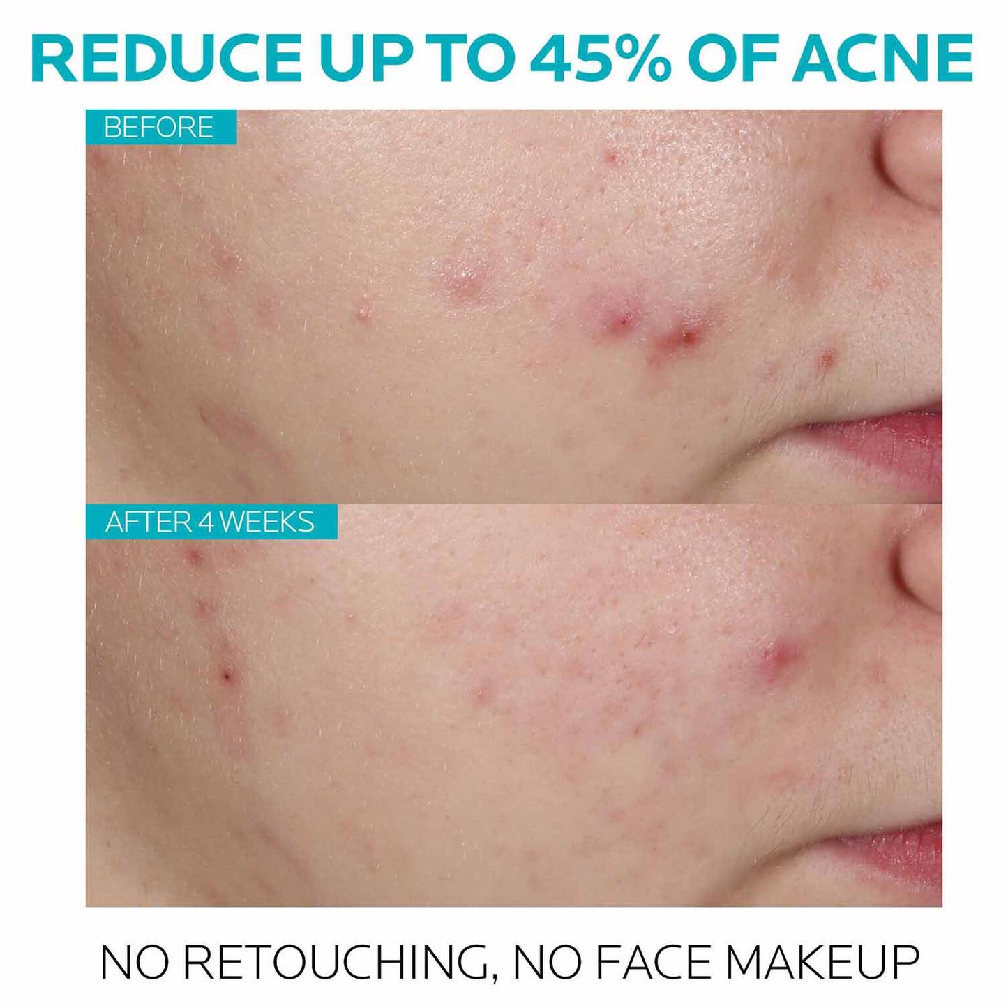 effaclar-salicylic-acid-acne-treatment-serum-j7 7_EffaclarSerum_After-45-days.jpg