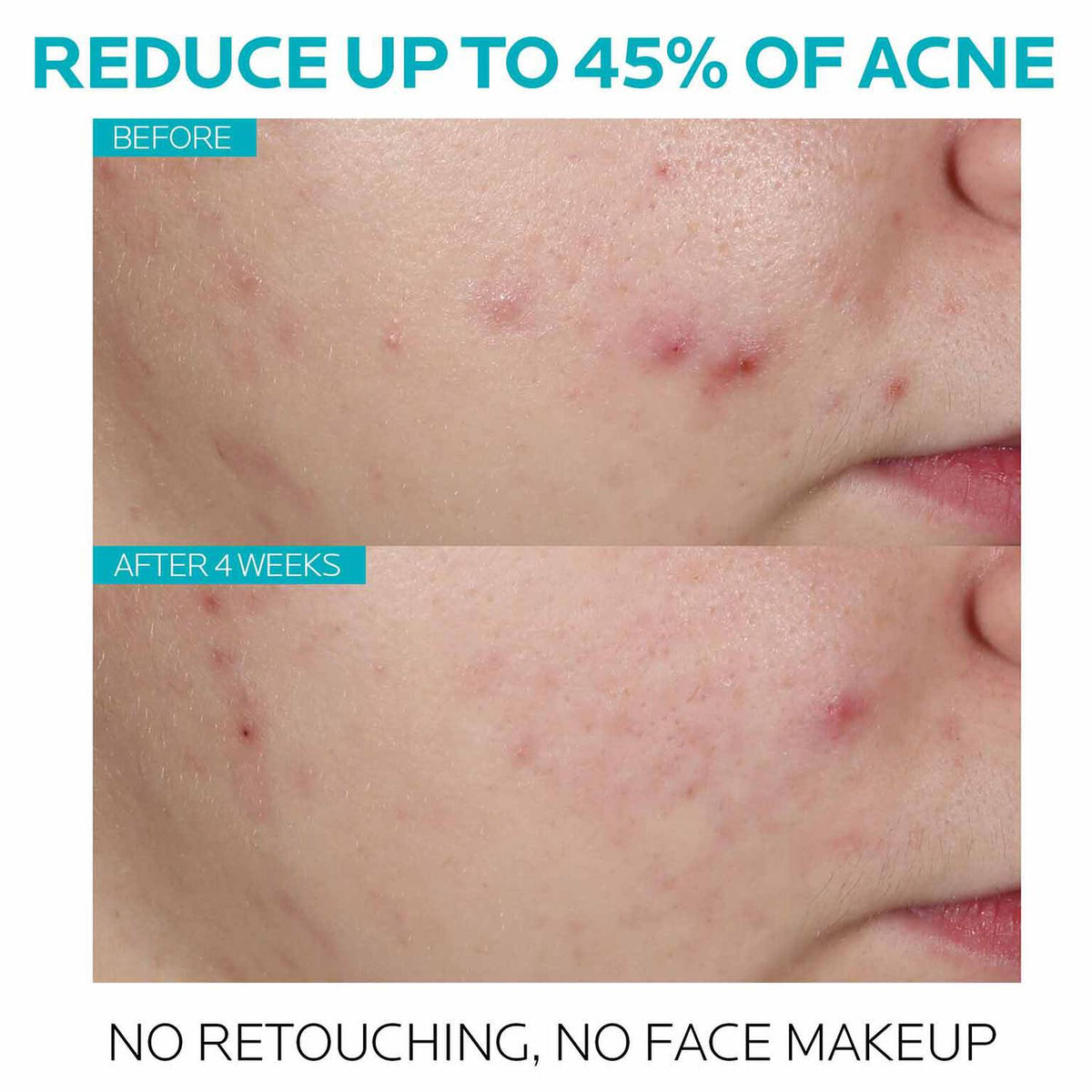 effaclar-salicylic-acid-acne-treatment-serum-j7 7_EffaclarSerum_After-45-days.jpg