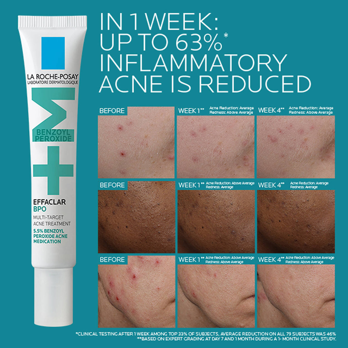 effaclar-bpo-multi-target-acne-treatment-with-5-5-benzoyl-peroxide-p1 EffaclarBPO-ClinicalBA-ATF-1500x1500-2.jpg