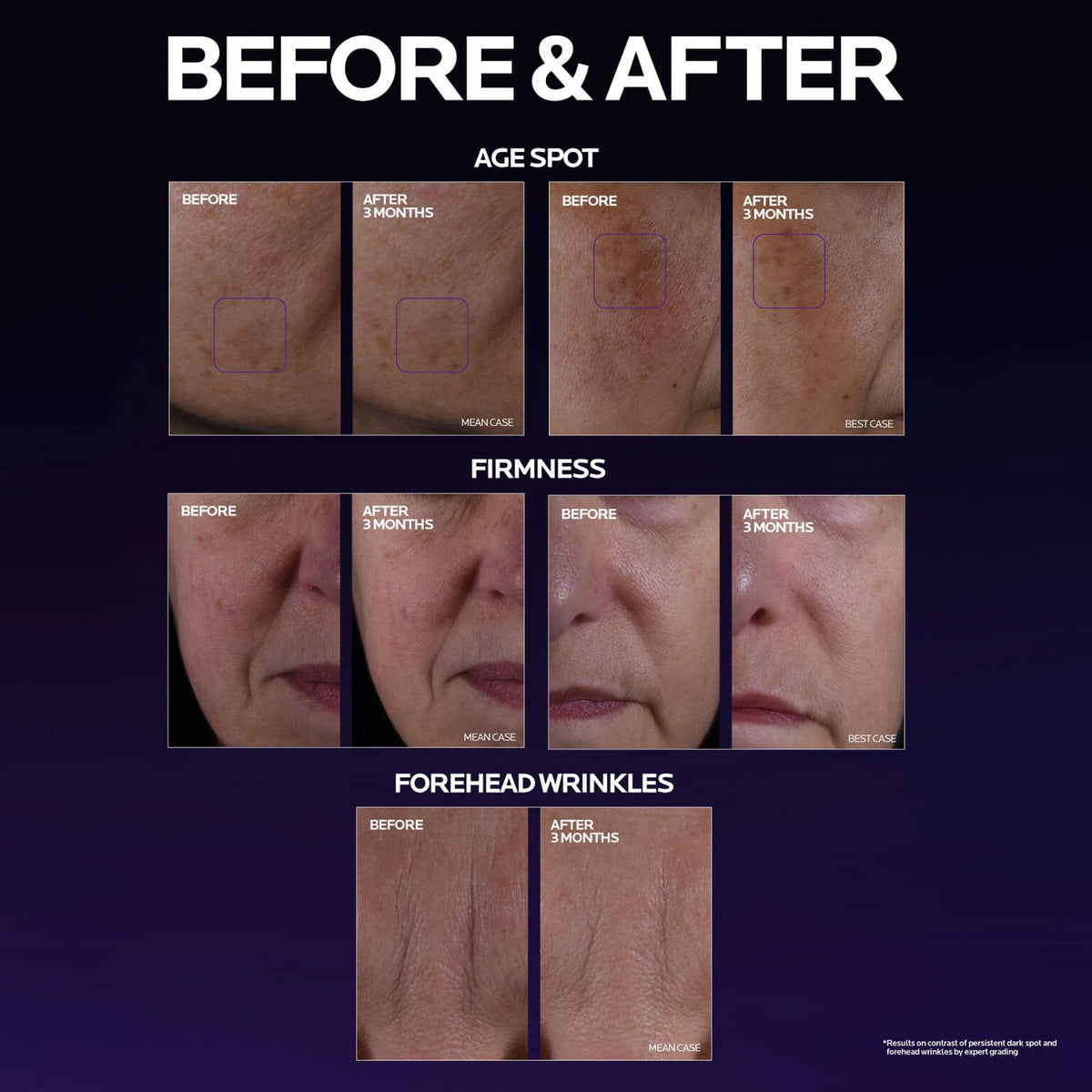 mela-b3-double-dose-discoloration-treatment-with-melasyltm-m9 MelaB3_DD_BTF_BeforeAfter_1500x1500_5.jpg